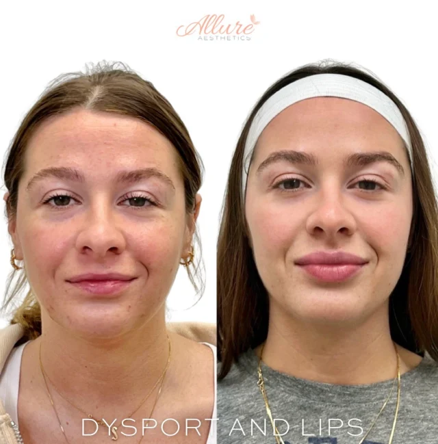 Dysport & Lips 💉✨

For this beautiful client, we focused on achieving hydrated, symmetrical lips with natural volume to enhance overall facial balance. The result? A softer, more harmonious look that perfectly complements her features. 👄

We also treated her upper face with Dysport to smooth out frown lines and forehead wrinkles — giving her a more refreshed, relaxed appearance. Her forehead now looks smoother with faint expression lines, creating that subtle, youthful glow. 💫