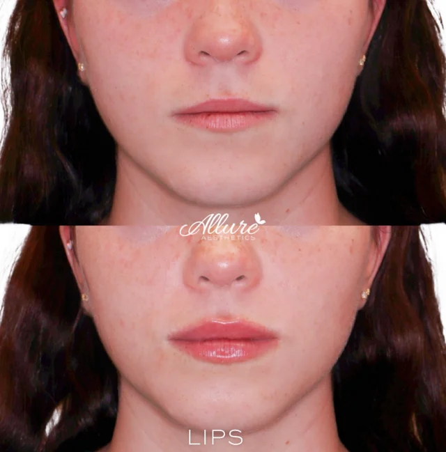 Lip Filler 💉

These are your lips — but better.✨🙌

For this client, we added more height, volume, and definition to enhance her natural shape while keeping everything soft and balanced.

✨ Hydration plays a major role in the overall look and feel of the lips, and this treatment delivered both structure and that healthy, plump glow.

Subtle. Polished. Perfectly tailored to you. 💋

Click the link in our bio to book now 
————————————————————
👩🏼‍⚕️Tanya Atiyeh Gallagher CRNP, AGPCNP-BC
👩🏼‍⚕️Taylor Romeo CRNP, AGPCNP-BC
👩🏼‍⚕️Cynthia Steckler, RN BSN
👩🏻‍⚕️Kelly Morell CRNP, FNP-BC
👩🏼‍⚕️Melissa Graber RN, LE

#TR #LipFiller #LipFillers #LipAugmentation #LipFillerBeforeAndAfter #LipFillerResults #JuvedermLips #FillerGoals #LipFillerTransformation #FullLips #KissableLips #NaturalLookingLips #LipInjections #PoutGoals #PlumpLips #LipFillerQueen #LipFillerSpecialist #LipFillerExpert #FillerTreatment #LipFillerJourney #LipEnhancement #DermalFillers #LipGoals