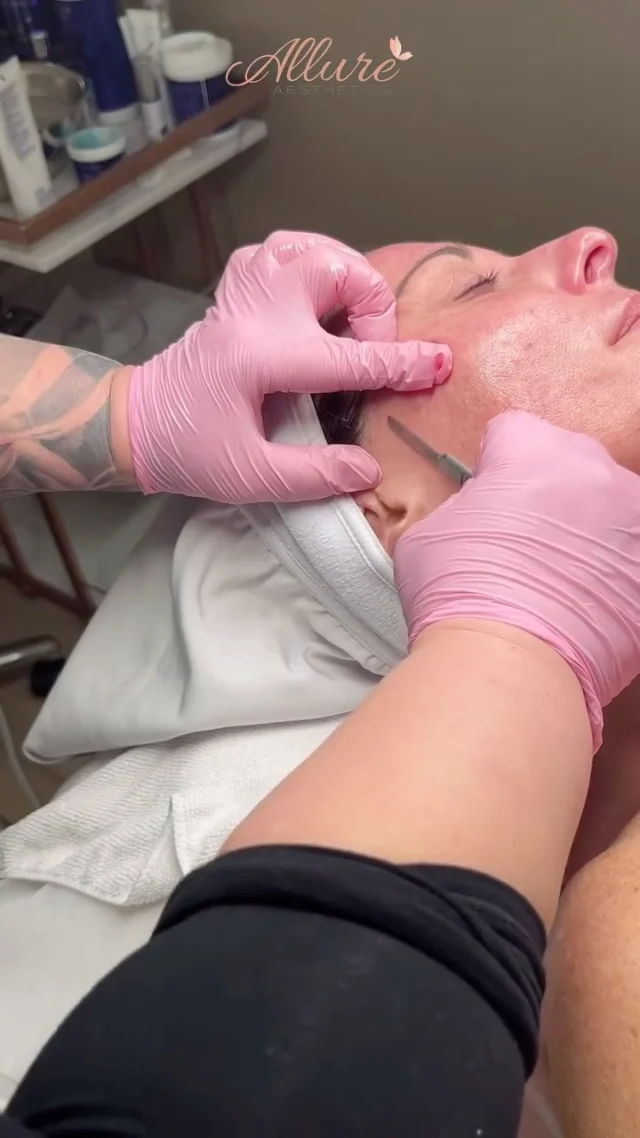 ✨ Say goodbye to dull, tired skin and hello to a glass-like glow ✨

Dermaplaning is one of our favorite skin-refreshing treatments — and it’s easy to see why. Using a sterile surgical blade, we gently exfoliate the top layer of dead skin cells and remove peach fuzz (vellus hair), leaving your skin incredibly smooth, bright, and baby-soft.

Here are 6 major benefits of dermaplaning:
 1.  Instant Glow-Up – Skin looks visibly brighter and more radiant
  2.  Flawless Makeup Application – Foundation goes on like silk
  3.  Deep Product Penetration – Your skincare absorbs more effectively
  4.  Smoother Texture – Say goodbye to rough patches and buildup
  5.  Minimized Appearance of Fine Lines – Gentle resurfacing = a softer look
  6.  No Downtime – Zero irritation, just results you can see and feel

We love showing our clients just how much buildup can sit on the skin — the results speak for themselves.

If your skin’s been feeling dull, congested, or just off — this is your sign. ✨