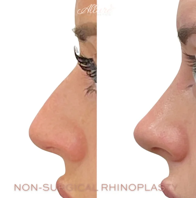 Non-surgical rhinoplasty 👃 can create one of the most refined transformations — no surgery, no downtime. 💉 

For this beauty, we smoothed out her dorsal hump and lifted the tip of her nose for a more balanced, elevated profile. Sculpted. Elevated. Absolutely stunning. ✨💞

Click the link in our bio to book now 
————————————————————
👩🏼‍⚕️Tanya Atiyeh Gallagher CRNP, AGPCNP-BC
👩🏼‍⚕️Taylor Romeo CRNP, AGPCNP-BC
👩🏼‍⚕️Cynthia Steckler, RN BSN
👩🏻‍⚕️Kelly Morell CRNP, FNP-BC
👩🏼‍⚕️Melissa Graber RN, LE

#nonsurgicalrhinoplasty #liquidnosejob #liquidrhinoplasty #nonsurgicalnosejob #nosefiller #nosecontour #medspa #medicalspa #facialaesthetics #injectables #facialbalancing #beautyboost #dermalfillers #aestheticmedicine #aestheticinjector #nonsurgicalnose #cosmeticinjectables #nosejobwithoutsurgery #nosefillerbeforeandafter #naturalresults