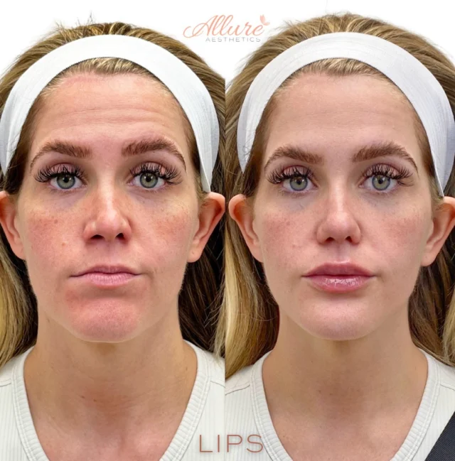✨ First-Time Lip Filler ✨

Thinking about lip filler for the first time? You’re in the right hands. 💉

We know that trying any new treatment can feel intimidating — that’s why we’re here to guide you through every step of the process. From your initial consultation to your final results, we focus on achieving a look that is natural, balanced, and beautifully enhances your unique features.

For this first-time client, we were able to:
💧 Add hydration to soften and refresh the lips
📏 Create height and volume for a fuller appearance
🎨 Define the lip border to enhance shape and symmetry

The result? Lips that still look like hers — just more hydrated, youthful, and defined.
