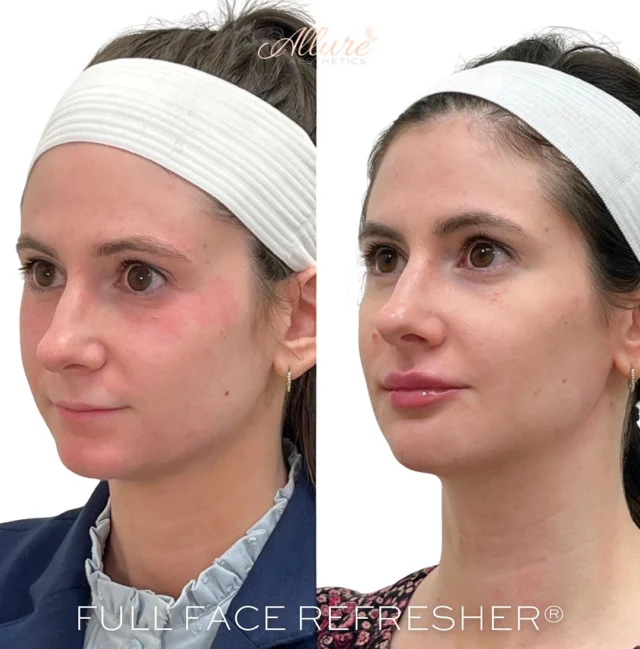 Full Face Refresher for this beautiful bride-to-be 👰‍♀️ ✨

We started with tox to target the lower face, including:
– DAO (depressor anguli oris) to soften downward pulling at the corners of the mouth
– Masseters to slim and contour the jawline
– Lip flip for a subtle enhancement of the upper lip
– And a touch to the chin to refine her profile

For filler, we focused on harmony and definition:
– Chin augmentation to add length and balance her side profile
– Jawline enhancement to sharpen and contour the lower face
– Lip filler for volume, hydration, and soft definition
– And chin shadow correction to smooth transitions and elevate the overall look

Every detail was customized to her unique facial structure, keeping things soft, elegant, and bridal-ready 💍💉

Click the link in our bio to book now 
————————————————————
👩🏼‍⚕️Tanya Atiyeh Gallagher CRNP, AGPCNP-BC
👩🏼‍⚕️Taylor Romeo CRNP, AGPCNP-BC
👩🏼‍⚕️Cynthia Steckler, RN BSN
👩🏻‍⚕️Kelly Morell CRNP, FNP-BC
👩🏼‍⚕️Melissa Graber RN, LE