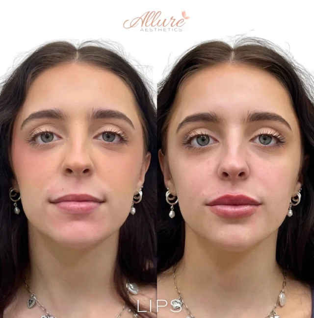 Lips 👄 

This beauty came in looking to enhance the overall shape and balance of her lips. She wanted more height and volume, with a focus on creating a fuller, yet natural look. We were able to beautifully define her Cupid’s bow, add structure to the top lip, and enhance the volume all around—especially in the lower lip—for a more symmetrical, plump appearance.