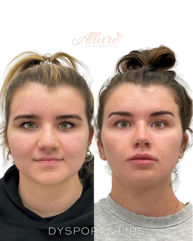 Dysport + Lips✨

We combined a few of our favorite treatments to give her a balanced, refreshed, and more sculpted look:

💉 Masseter Slimming: We treated her masseter muscles to help soften the jawline and create a slimmer, more V-shaped facial profile. This not only enhanced her natural contours but also helped with any tension from clenching or grinding.

💉 Dysport (Upper Face + Lip Flip): We smoothed fine lines and wrinkles across her forehead, frown lines, and crow’s feet for a naturally lifted and rejuvenated appearance — all while preserving her expressions. We also included a subtle lip flip by placing Dysport above the upper lip, helping the lip gently roll outward to create a fuller, more visible top lip without adding volume.

💉 Lip Filler: We enhanced both the upper and lower lips, giving her more height, volume, and hydration. Her Cupid’s bow is now beautifully defined, and the lips have a more symmetrical, structured shape that flatters her entire face.

Every detail was customized to complement her features — natural, balanced, and beautifully enhanced. ✨

#CS #LipFiller #Dysport #Botox #AntiAging #SelfCare #SkincareRoutine #YouthfulSkin #WrinkleFree #Aesthetics #SkinGoals #BeautyEnhancement #PreventativeBotox #LipGoals #FillerBeforeAndAfter #GlowUp #SmoothSkin #Injectables #SkinConfidence  #FreshFace