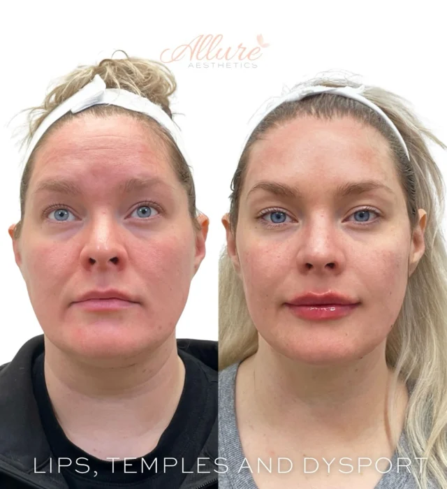 ✨ Lips, Temples, & Upper Face Dysport ✨

For this beauty, we addressed multiple areas to create a refreshed, youthful, and beautifully balanced look:

💋 Lips – We focused on enhancing her natural shape by adding volume, definition, and hydration. We also sculpted a more structured Cupid’s bow, which gave her upper lip that elegant, heart-like curve—perfect for a fuller, yet still natural-looking pout.

💉 Temples – Often overlooked, the temples play a major role in facial harmony. As we age, we naturally lose volume in this area, which can create a hollow or sunken look. By restoring volume to her temples, we were able to reframe her face and create a smoother, more youthful contour. This subtle enhancement also supports the overall structure of the upper face, making a big difference without looking “done.”

✨ Upper Face Dysport – To finish, we smoothed out her forehead lines, glabella (between the brows), and crow’s feet with Dysport. This helped relax overactive muscles and softened existing fine lines, giving her that refreshed, well-rested appearance—without compromising her natural expression.

Every detail was tailored to enhance her beauty while keeping the results soft and refined. ✨