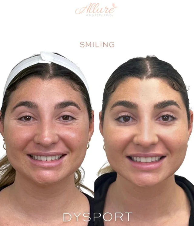 ✨ Dysport ✨

For this beauty, we focused on upper face Dysport—and the results speak for themselves.

➡️ Smiling: Notice how her crow’s feet have softened dramatically. The fine lines at the corners of her eyes and underneath them are visibly diminished, giving her a more refreshed, rested look—without losing her natural smile.

➡️ Frown Face: In her before photo, you’ll see noticeable “11 lines” between her brows—those vertical creases that can make the face look tense or stressed. After treatment, those lines are significantly smoothed, creating a softer, more youthful expression.

➡️ Raised Brows: Even though her forehead lines weren’t deeply etched, Dysport helped to preserve a smooth, even texture and subtly lifted look. This not only enhances her overall glow but also helps prevent those deeper lines from forming over time.