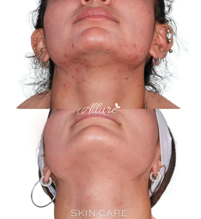 ✨ The Power of Customized Skincare ✨

When it comes to achieving real results, there’s no one-size-fits-all — and this transformation is proof.

This beautiful client came to us struggling with persistent acne along her chin and jawline extending down to her neck. Just one month later, her skin is clearer, calmer, and visibly healthier — and here’s what made the difference:

🌿 Nutrafol Clear Skin Supplements – targeting acne from within by balancing hormones and reducing inflammation
🧴 ZO Skin Health Products – medical-grade skincare customized to her skin needs
💉 Microneedling Sessions – stimulating collagen and improving texture while reducing breakouts

Consistency, professional guidance, and a tailored regimen = visible results in just 30 days. 💥

✨ Ready to start your skin journey? Click the link in our bio to schedule a consultation.