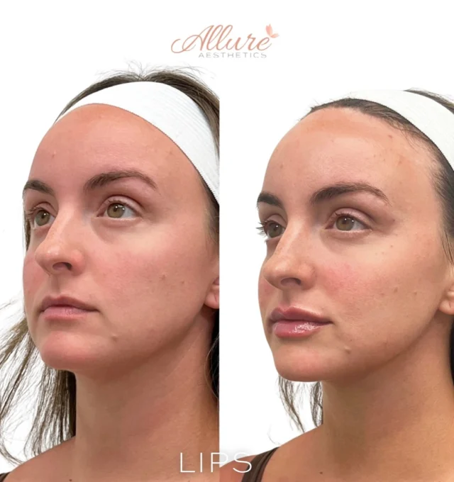 💋 First Time Lips! 💋

For this beauty’s very first lip filler treatment, we focused on creating a natural, balanced enhancement. ✨
✔ Defined her Cupid’s bow for a beautifully sculpted shape
✔ Added symmetry and proportional height to both lips
✔ Enhanced overall volume while keeping a soft, natural look

The result? Fresh, youthful lips that perfectly complement her features — subtle enough for a first-timer, yet stunning enough to turn heads. 💖

📅 Ready for your own first-time lip transformation? Book your appointment today!

Click the link in our bio to book now 
————————————————————
👩🏼‍⚕️Tanya Atiyeh Gallagher CRNP, AGPCNP-BC
👩🏼‍⚕️Taylor Romeo CRNP, AGPCNP-BC
👩🏼‍⚕️Cynthia Steckler, RN BSN
👩🏻‍⚕️Kelly Morell CRNP, FNP-BC
👩🏼‍⚕️Melissa Graber RN, LE

#fullfacerefresher #medspa #medicalspa #skincare #skin #glowingskin #beauty #antiaging #aesthetics #facial #facials #esthetician #skincareroutine #healthyskin #botox #dysport #injectables #fillers #smilelines #lipfiller #lipfillers #cheekfillers #dermalfillers #microneedling #hydrafacial #laserhairremoval #dermatology #selfcare #laser #TR