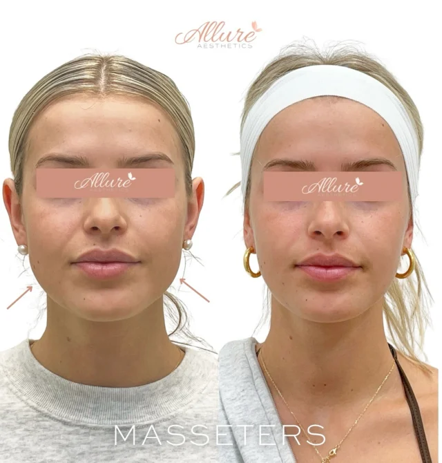 ✨ Facial Slimming with Dysport® ✨

For this beauty, we focused on her masseter muscles — the strong jaw muscles used for chewing and clenching. Over time, these muscles can become enlarged from things like grinding teeth, stress, or jaw tension, creating a wider or more square-shaped lower face.

By strategically injecting Dysport® into the masseters, we were able to:
✔ Relax the overactive jaw muscles
✔ Slim the lower face for a softer, more V-shaped contour
✔ Reduce jaw tension & discomfort from clenching or grinding
✔ Enhance her overall facial balance and harmony

The result? A more refined, feminine jawline that still looks completely natural — just softer and more sculpted. 💖

📅 Book your consultation today to see if masseter slimming is right for you!