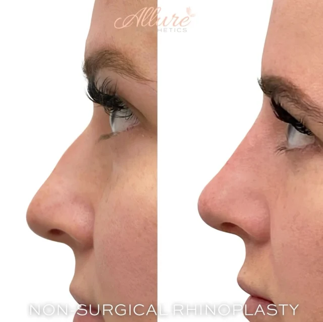 Liquid rhinoplasty involves the use of expertly placed filler to subtly sculpt and refine the shape of the nose.

This first-time patient achieved these amazing results in just one appointment.

-No surgery.
-No downtime.
Just artfully placed filler and refined balance.

#nonsurgicalrhinoplasty #liquidnosejob #nonsurgicalnosejob #liquidrhinoplasty #nosefiller #rhinoplastywithoutsurgery #liquidnose #nonsurgicalnose #nonsurgicalnoseaugmentation #nosecontouring 

Click the link in our bio to book now 
————————————————————
👩🏼‍⚕️Tanya Atiyeh Gallagher CRNP, AGPCNP-BC
👩🏼‍⚕️Taylor Romeo CRNP, AGPCNP-BC
👩🏼‍⚕️Cynthia Steckler, RN BSN
👩🏻‍⚕️Kelly Morell CRNP, FNP-BC
👩🏼‍⚕️Melissa Graber RN, LE