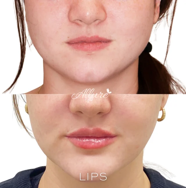 Our gorgeous client received a personalized treatment plan to enhance her natural beauty:

 Fillers✨

💋 Lip Filler – for volume and a defined shape

💉 Chin Filler – to balance the lower face and smooth the chin dimple

Neuromodulators✨

Nasal Flaring – to reduce nasal movement for a smoother profile.

Masseter – to slim the jawline and ease muscle tension.

DAO – to lift the corners of the mouth.

To achieve these stunning results, our client invested around $2,000 in her customized treatment plan. 💞✨
