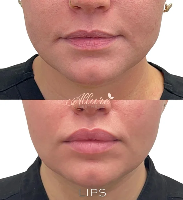 This beauty started with completely natural lips, and after three subtle treatments, she now has a soft, natural look that feels effortlessly balanced.✨

As filler settles, it integrates with the tissue, refining shape and symmetry. It can take up to four weeks for everything to fully settle and reveal the final result. 💞

Curious to learn how filler can subtly add volume and shape to your lips? Schedule a consultation today! 💋