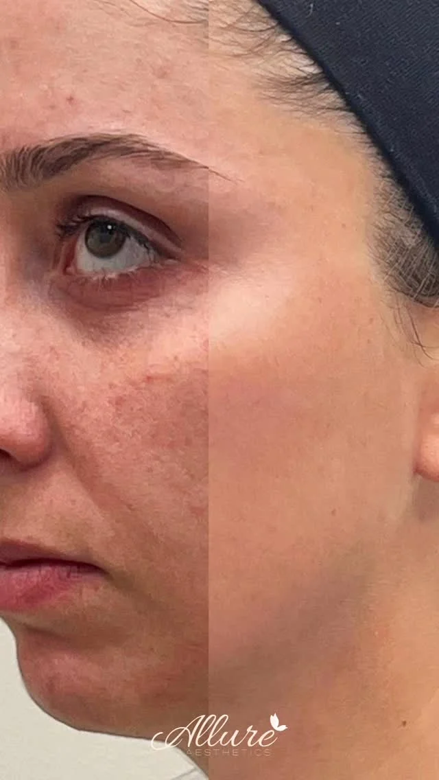 ✨ Real results, real glow. ✨

Our client’s journey with SkinPen® Microneedling shows how powerful collagen stimulation can be. By creating controlled micro-injuries, SkinPen helps smooth texture, reduce acne scarring, and bring out that healthy, radiant glow. 🌟

Ready to transform your skin? Book your customized treatment at Allure Aesthetics today.