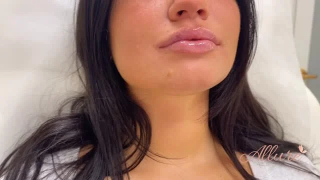 ✨ Freshly enhanced, beautifully balanced. 

Watch these lips transform from every angle — front, side, and profile — with precise filler artistry. At Allure Aesthetics, our focus is natural harmony, contour, and confidence that shines the moment you leave our chair. 💉💋

#LipFiller #LipFillers #LipFillerBeforeAndAfter #LipsOnFleek #PerfectPout #PoutGoals #JuicyLips #KissableLips #LipEnhancement #LipAugmentation #LipInjections #LipInjector #FillerQueen #FacialFillers #DermalFillers #AestheticMedicine #MedicalSpa #MedSpaLife #CosmeticInjectables #BeautyEnhancement #NonSurgical #AntiAgingClinic #YouthfulGlow