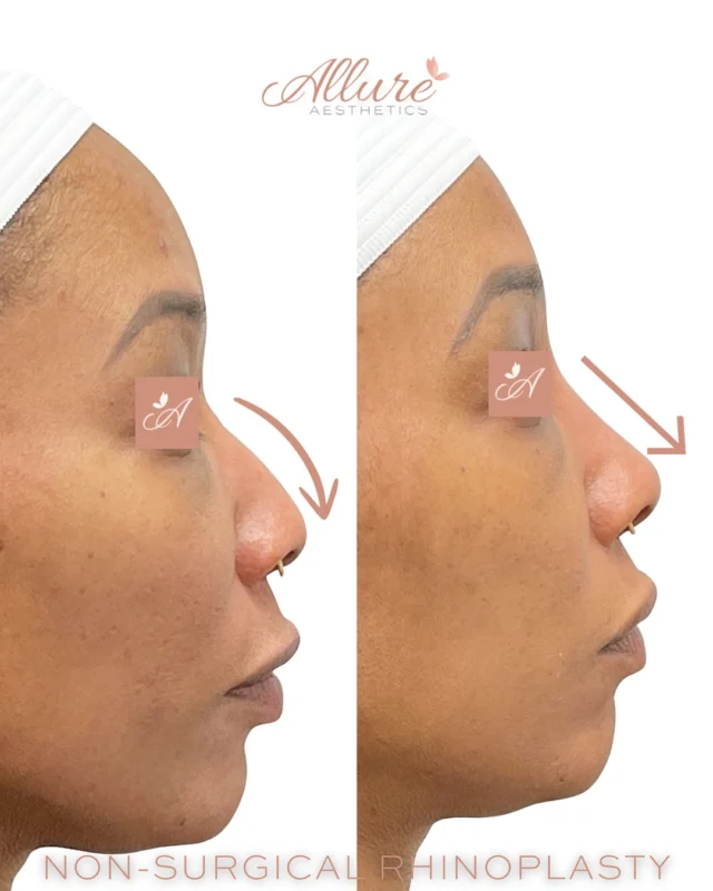 ✨Liquid Rhinoplasty✨

The patient presented with a downward-shaped, hooked nose. To enhance facial harmony and create a more balanced nasal profile, 💉 1 syringe of dermal filler was expertly injected along the nasal bridge. This non-surgical approach effectively straightened the contour, resulting in a more refined and proportionate appearance. 👃💫

Our providers specialize in liquid rhinoplasty. Ready to learn more? 📅Schedule your consultation today.

#nonsurgicalrhinoplasty #liquidnosejob #nonsurgicalnosejob #liquidrhinoplasty #nosefiller #rhinoplastywithoutsurgery #liquidnose #nonsurgicalnose #nonsurgicalnoseaugmentation #nosecontouring