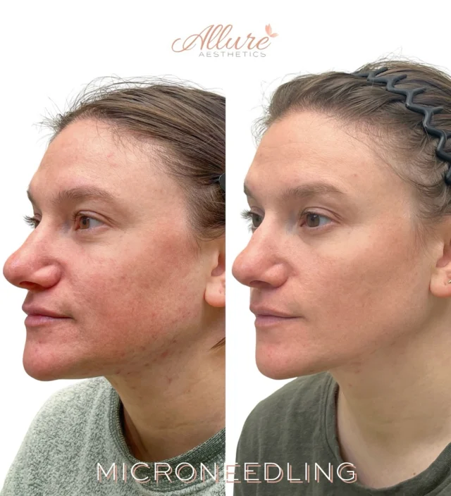 ✨ Real Results After 4 Microneedling Sessions ✨

This beautiful client came to us struggling with active acne, acne scarring, and uneven texture. After just 4 microneedling sessions, her skin is visibly clearer, smoother, and more radiant. 💫

✅ Reduced active breakouts
✅ Minimized appearance of acne scars
✅ Improved skin tone and texture

Microneedling works by stimulating your skin’s natural healing process and boosting collagen production.

#Microneedling #MicroneedlingTreatment #MicroneedlingResults #SkinCare #SkincareRoutine #GlowingSkin #HealthySkin #SelfCare #SelfCareRoutine #MedicalSpa #MedSpaLife #MedSpaTreatment #FacialTreatment #Facials #DermaPlaning #DermaplaningTreatment #AntiAgingSkinCare #CollagenBoost #SkinRejuvenation #ClearSkinJourney #BeautyClinic #SkinCareClinic #SpaDayEveryday #FaceTreatment #RadiantSkin
