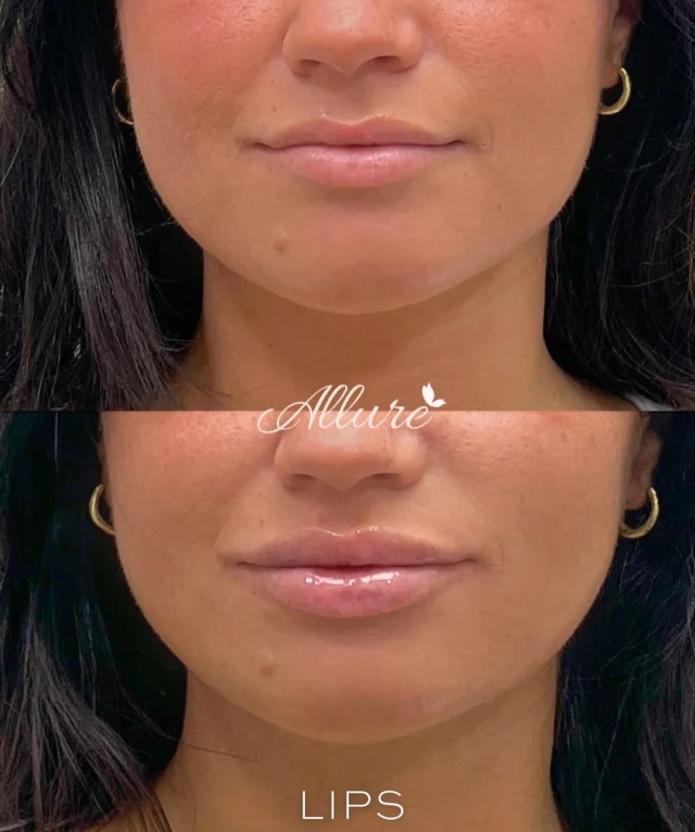 This client wanted to maintain her natural lip shape 💋 while enhancing volume and definition. With strategically placed filler, we achieved a fuller, more balanced pout that still looks uniquely hers. 😍

#lipfiller #lipfillers #lips #lipaugmentation #lipinjections #medspa #medicalspa #aesthetics #injectables #beautyboost #selfcare #selfimprovement #confidenceboost #naturalresults #lipgoals #plumplips #facialaesthetics #nonsurgical #skingoals #beautytreatments #dermalfillers #beforeandafter #skincaregoals #TR #glowup
