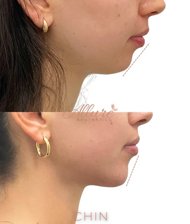✨ Before & After – Chin Filler ✨

This patient received 1 syringe of  filler to the chin, and the improvement in her profile is a great example of how subtle enhancements can create significant facial harmony.

We assessed her profile using Ricketts’ E-Line, a well-established standard in facial aesthetics.

👉 What is Ricketts’ E-Line?
The E-Line (Esthetic Line) is drawn from the tip of the nose to the tip of the chin. In ideal facial proportions:

The upper lip should sit ~4 mm behind the line

The lower lip ~2 mm behind

When the chin is under-projected, the lips may appear more prominent, creating imbalance. In this case, chin filler brought her closer to ideal proportions—without altering her natural features.

⏱️ Results: Immediate, with minimal downtime
📩 DM to schedule a profile assessment or consultation

#ChinFiller#JawlineFiller#ProfileBalancing#MedicalSpa#AestheticsClinic#FacialContouring#Injectables#DermalFiller#NonSurgical#BeautyEnhancement#SelfCareJourney#ConfidenceBoost#SelfImprovement#NaturalResults#AestheticMedicine#MedSpaLife#SkincareGoals#GlowUp#FacialHarmony#AntiAging#CosmeticInjector#BeautyConfidence#ChinEnhancement#WellnessAndBeauty#FacialRejuvenation