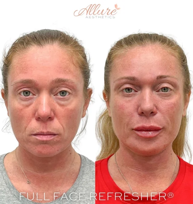 These results truly speak for themselves. ✨

This patient has trusted Allure since 2021, staying consistent with her Full Face Refresher® treatment plan, designed around her unique features and goals.

Her concerns included fine lines, volume loss, and lack of definition. Through a customized combination of wrinkle relaxers and expertly placed filler, we’ve smoothed and softened lines, refreshed the under eyes, added lift to the cheeks, and enhanced jawline and chin definition.

The result? A naturally youthful, balanced look that evolves beautifully over time.

#FullFaceRefresher #Injectables #FacialBalancing #Dysport #BotoxResults #BeautyBeforeAndAfter #AntiAgingTreatment #YouthfulGlow #NonSurgicalRejuvenation #NaturalResults #AestheticsClinic #MedicalAesthetics #SkinGoals #AgingGracefully #FacialRejuvenation #GlowUpJourney #BeautyTransformation #MedSpaResults #AestheticInjector #LipFillerResults #CheekFiller #JawlineFiller #SmoothSkinGoals #ConfidenceBoost #SelfCareJourney #CS