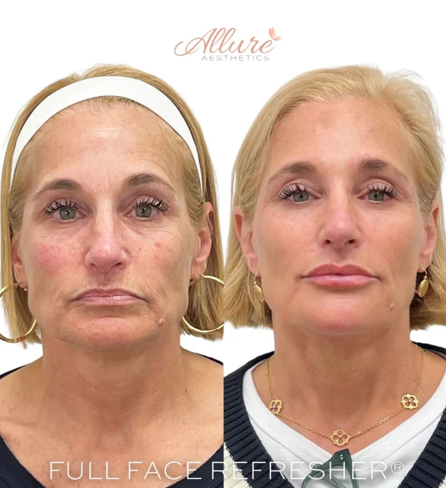 Consistent care creates lasting beauty ✨

This gorgeous client has been committed to her aesthetic journey since 2024. In just over a year, and through six thoughtfully planned appointments, she’s achieved a stunning, natural transformation.

Her customized full face refresher included:
💉 Neuromodulators to smooth and soften lines
💋 Lip filler to lift and plump for a refreshed, happy expression
💫 Cheek, temple, chin, and jawline filler to define and harmonize her features

A reminder that true transformation isn’t a single treatment — it’s the result of consistency, expertise, and trust in the process.