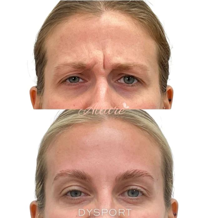 Let’s talk neuromodulators 💉

For this beauty, we used Dysport to smooth lines while keeping some natural movement in the glabella, just as she requested! ✨

By adjusting dosing (how many units are used), we can tailor your results to be completely smooth or more natural with soft expression.

We recommend treating every 3 months to maintain your results.

Results may vary.

#AntiAging#YouthfulSkin#BotoxResults#BotoxBeforeAndAfter#WrinkleFreeSkin#SmoothSkinGoals#AgeGracefully#BeautyEnhancement#MedSpaLife#MedicalAesthetics#SkincareGoals#BotoxSpecialist#AestheticClinic#NonSurgicalTreatment#FaceRejuvenation#InjectablesExpert#AntiWrinkleTreatment#YouthfulGlow#AgelessBeauty#SkinRejuvenation#BeautyConfidence#GlowUpSkin#BeautyWithoutFilter#SkinGoals#AgingBackwards