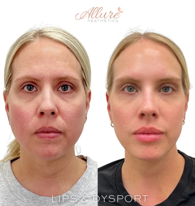 Lips + Dysport ✨

For this beautiful client, we enhanced her natural features with a customized treatment plan.

We added definition, hydration, and soft volume to her lips, creating a naturally balanced, refreshed look 💋.
We also treated her with Dysport in the upper face for a smooth, lifted appearance and in the masseters to achieve a softer, more contoured look.

Because subtle enhancements make the biggest difference 🤍

#AllureAesthetics #LipFiller #Dysport #FacialBalancing #MasseterSlimming #NaturalResults #FacialContouring #HydratedLips #NonSurgicalEnhancement #ConfidenceInYourSkin #AestheticsExpert #BeautyRedefined #Rejuvenation #MedSpa #AllureGlow