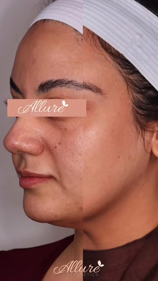 ✨ Custom ZO Skincare Transformation ✨

When it comes to skin, there’s no one-size-fits-all. Every product, every step, and every result is fully customized to you.

Our client came in with:
🌿 Uneven texture
🌿 Post-acne hyperpigmentation
🌿 Visible pores and dullness

Through a customized ZO Skin Health regimen, we focused on refining texture, fading pigment, and restoring balance, targeting the root, not just the surface.

You can see the difference:
✔️ Smoother, more refined texture
✔️ Brighter, even tone
✔️ Minimized pores
✔️ Healthy, radiant glow

This is the power of custom skincare designed for your skin, not someone else’s.

💧 Ready to customize your glow?
DM us or tap the link in bio for your personalized skin consultation.