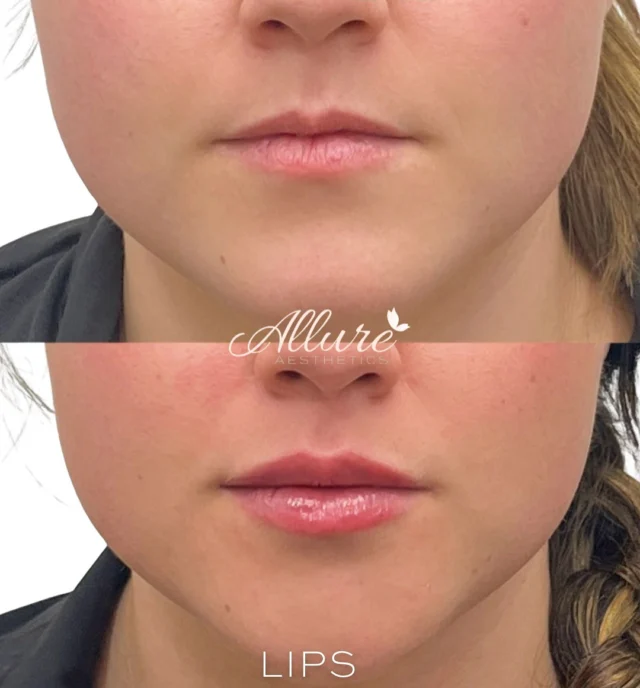 Soft. Natural. Beautiful 👄 

We enhanced her lips in just one session, adding subtle definition and hydration while keeping a naturally balanced look.✨💞

#LipFiller #NaturalLips #LipEnhancement #HydratedLips #LipGoals #SubtleEnhancement #LipInjections #BeforeAndAfter #LipsByAllure #MedSpaBeauty #NaturalResults #BeautyEnhancement #AestheticsClinic #JuvedermLips #RestylaneLips #LipFillerExpert #LipContour #DermalFillers #GlowUp #AllureAesthetics #HoustonMedSpa #InjectorLife #ConfidenceInEverySyringe #NaturalAesthetics #PerfectPout