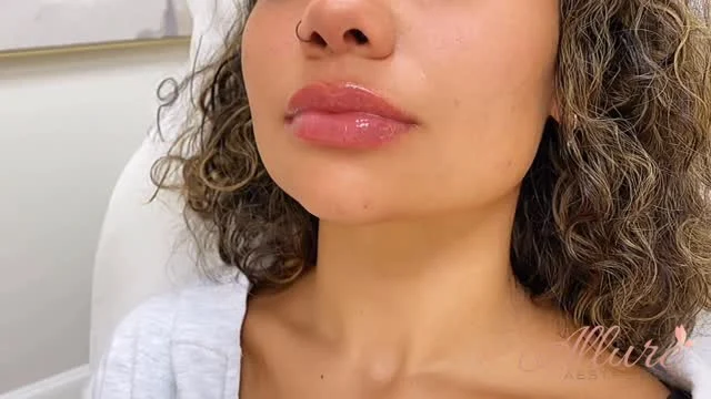 ✨ Freshly Injected Lips 💉

Hydrated, plump, and perfectly balanced - this is what freshly injected looks like. Straight off the syringe, you can already see the definition, symmetry, and smooth contour that give that signature Allure Aesthetics finish.

Every set of lips is custom-sculpted to enhance your natural beauty - never overfilled, never artificial. Swelling will soften over the next few days, leaving behind a hydrated, pillowy pout with seamless shape and natural movement.

✨ Customized. Precise. Allure. ✨
Book your lip appointment today and experience why subtle artistry makes all the difference.
