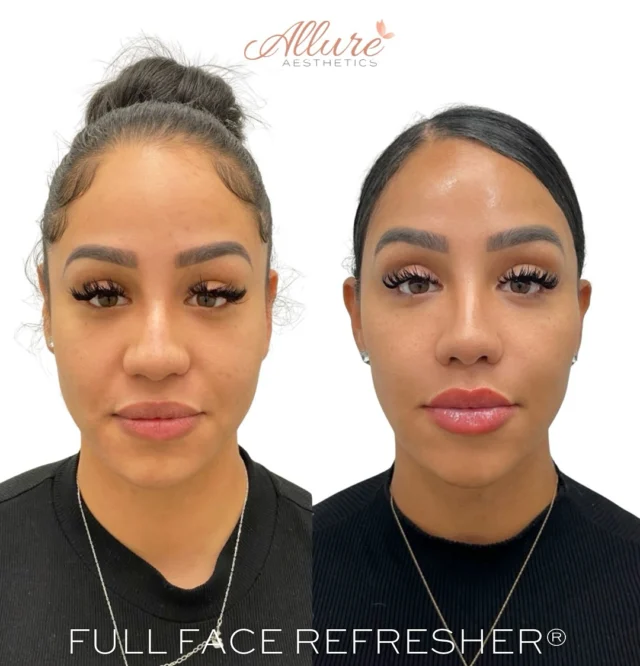 ✨ Full Face Refresher® ✨

For this beautiful client, consistency has been key. She’s been keeping up with her Full Face Refresher® since 2020, and her results speak for themselves - refined, balanced, and naturally enhanced. 💉

Her customized treatment plan included:
✨ Temples
✨ Cheeks
✨ Full-Face Dysport
✨ Smile Lines
✨ Jawline + Chin
✨ Lips
✨ Moxi/BBL Combo 

When filler is placed strategically and maintained properly over time, it doesn’t look “overdone”  it simply helps preserve your structure, lift, and youthful glow. This is what natural longevity looks like when artistry meets medical precision. 🤍