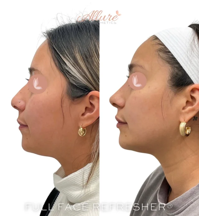 Full Face Refresher®✨

This beauty has been keeping up with her full face refresher since 2022 and the results speak for themselves. Through careful facial balancing, we were able to enhance her natural features while maintaining harmony and proportion across the entire face.

✨ Nose: Subtle contouring and refinement to smooth irregularities and create a more balanced profile without surgery.
✨ Jawline: Definition and structure that frame her face beautifully, giving her a sculpted and youthful appearance.
✨ Dysport (Upper Face): A refreshed, softened look that smooths fine lines while keeping her natural expressions intact.
✨ Masseters: Slimming the lower face by relaxing the masseter muscles for a more contoured, feminine silhouette.
✨ Cheeks: Added lift and volume for a rejuvenated, elevated look that enhances her bone structure.
✨Lips: Perfected balance with subtle volume and hydration — enhancing her smile while keeping it elegant and natural.

The art of facial balancing isn’t about changing your face, it’s about highlighting your best features and maintaining timeless beauty year after year.💞🙌