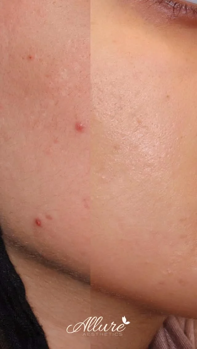 SkinPen Microneedling ✨

In just two sessions, this beauty saw a major improvement in her skin. 💫

She came to us with acne scarring, uneven texture, and pigmentation and look at her now. Her complexion is smoother, her tone is brighter, and that confidence glow is undeniable. 🤍