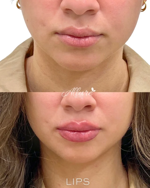 Hydrated. Balanced. Beautiful ✨

These stunning results were achieved in one session with just one syringe - enhancing shape, adding subtle volume, and restoring youthful hydration.
When artistry meets expertise, the results speak for themselves 👄💉