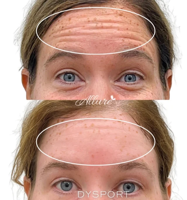 Strong facial expressions are a beautiful part of who we are but over time, repetitive movements can lead to fine lines and deeper etched wrinkles 👋🏼💉

In these photos, you’ll see how Dysport helps soften:

✨ Forehead lines when the brows are lifted - smoothing horizontal wrinkles and keeping movement natural
✨ 11’s (frown lines) between the brows + lines across the nose - relaxing harsh creases that can make us appear tired or tense
✨ DAO (downturned corners of the mouth) - lifting the area to restore a more uplifted and naturally confident expression

The result?
A refreshed, youthful look that still looks like you - just smoother ✨

📲 Ready to prevent or soften fine lines? Send us a DM to book your consultation!