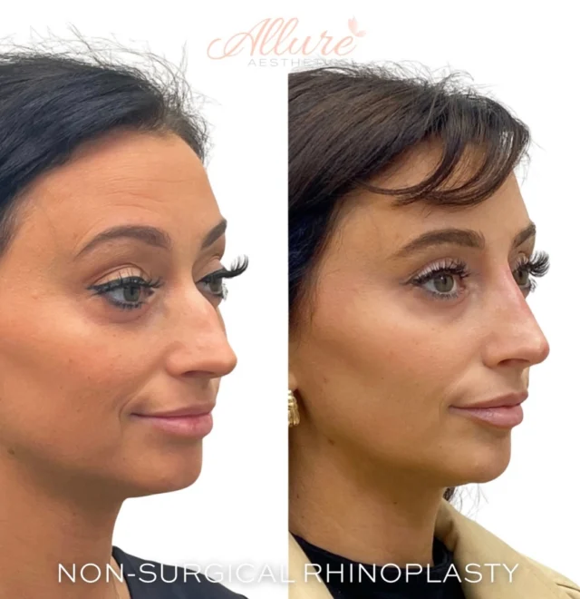 ✨Non-Surgical Rhinoplasty✨
Expert contouring without surgery

With strategic dermal filler placement, we were able to camouflage the dorsal hump, refine her profile, and create the illusion of a smaller, more balanced nose — all while maintaining her natural features.

By building subtle support and projection in key areas, we improved the nasal bridge alignment and enhanced facial harmony from every angle. No cutting. No downtime. Just precision artistry and anatomical expertise.

📌 Instant results
📌 Minimal discomfort
📌 Natural-looking enhancement

Confidence looks great on her 😍
Book your consultation and discover what a non-surgical nose transformation can do for you.