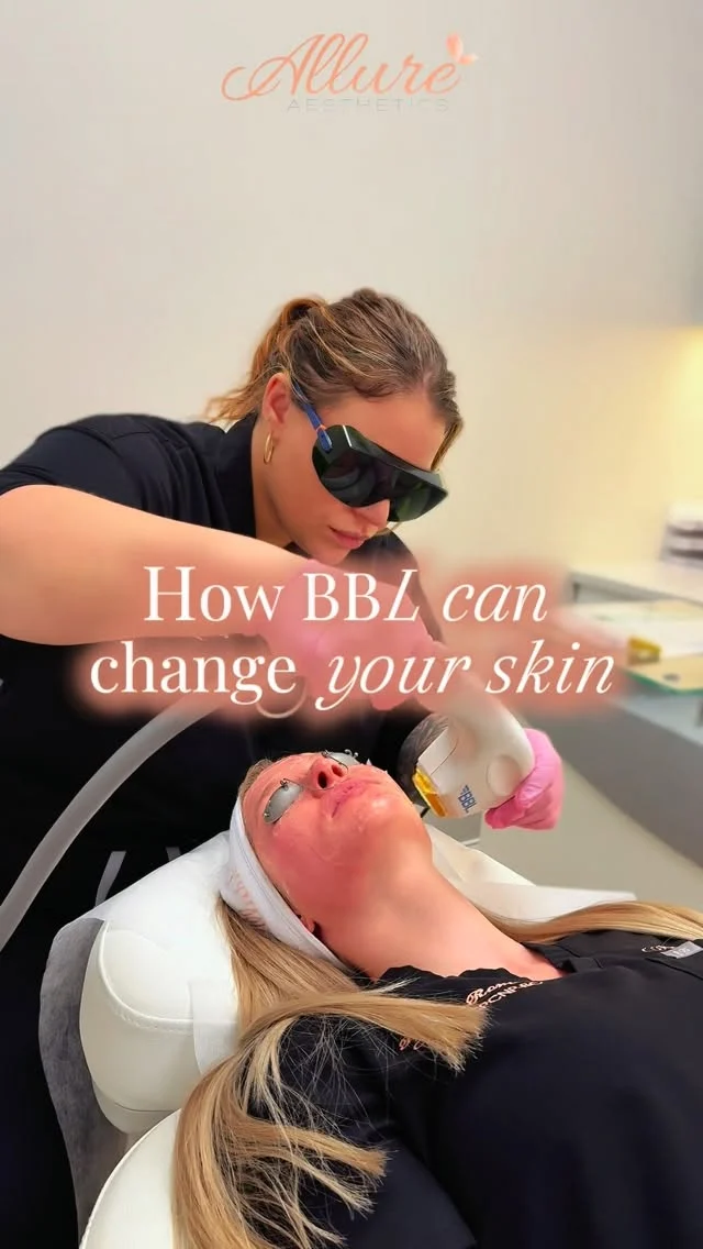 ✨ The power of BroadBand Light (BBL) ✨
BBL is often mistaken for a laser — but it’s actually advanced light therapy, making it gentler, safer, and incredibly effective for skin correction and rejuvenation.

Unlike traditional lasers that focus on one specific wavelength, BBL delivers broad-spectrum light to target multiple concerns at once. This means we can improve sun damage, redness, pigmentation, acne, fine lines, uneven texture, and overall tone—all in one treatment.

BBL works by sending pulses of light into the skin to stimulate collagen production and correct discoloration at the source, revealing a clearer, smoother, more youthful complexion over time. The best part? Minimal downtime with long-lasting results.

Think of BBL as a reset for your skin—correcting the past while protecting the future. ✨

Healthy skin isn’t just about looking good today… it’s about maintaining it for years to come.