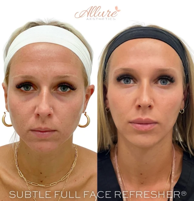 ✨ Subtle Full Face Refresher® ✨

For this beautiful client, we focused on soft, natural enhancements:

✨Under Eyes: She struggled with dark circles and hollowness — a light refresh instantly brightened and awakened her entire look.
✨Lips: We added symmetry and refined the shape, giving her upper lip more definition while keeping everything soft and natural.
✨Dysport: A smooth touch to soften fine lines and wrinkles while maintaining movement and expression.
✨Chin: A subtle enhancement to help balance her profile and elevate her overall facial harmony.

A refreshed, radiant version of her - never overdone. ✨

Results may vary 💞