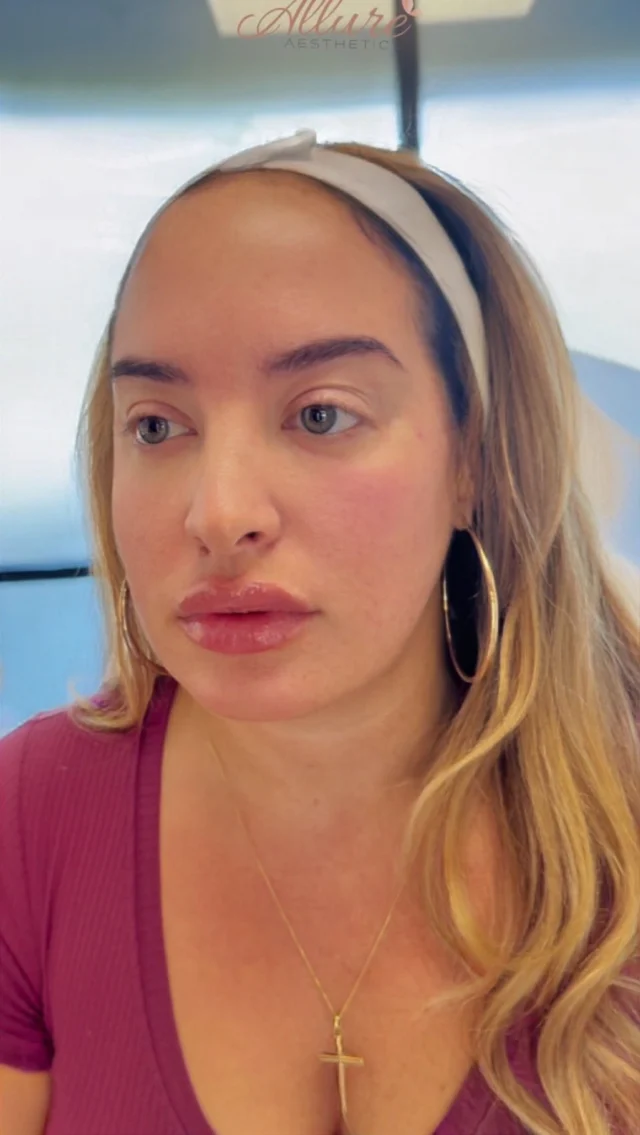 ✨ The Art of Subtle, Natural Results ✨This beautiful client has been trusting our artistry since 2020, and her results speak for themselves.

Her personalized treatment plan includes:
💉 Full-face balancing
💉 Dysport
💉 Lips
💉 Cheeks
💉 Under-eye rejuvenation

We focus on enhancing what’s already there - soft, natural, and timeless results that age gracefully with you.

#AllureAesthetics #dysport #ChinFiller #ProfileBalancing #FacialBalancing #antiaging #beforeandafter #MedicalAesthetics #NaturalResults #DermalFiller #AestheticInjector #FacialHarmony #BeautyEnhancement #ConfidenceLooksGoodOnYou #AestheticsClinic #AllureBeauty #MedSpa #AestheticMedicine #NonSurgicalEnhancement #FillerGoals #AllureResults #PhillyMedSpa
