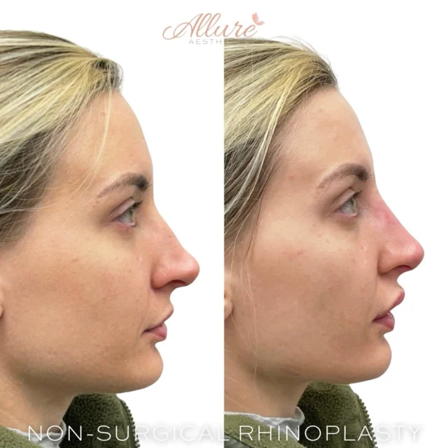 Non-Surgical Rhinoplasty 👃 

A non-surgical rhinoplasty uses advanced dermal fillers to smooth bumps, refine contours, and create a more balanced profile, all without incisions, anesthesia, or downtime.

Results are immediate, fully customizable, and designed to complement your natural features.

💞 Results may vary.