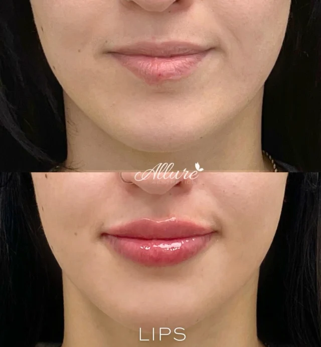 For this beautiful client, we used two syringes over two sessions to enhance - not overpower- her natural lips. By focusing on lip height, symmetry, and hydration, we were able to softly define her Cupid’s bow while creating a more balanced, refreshed appearance. Subtle changes. Beautiful results.

✨ Results may vary