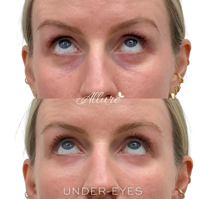 The under-eye area is one of the first places to show fatigue.

When hollowing and shadowing are addressed properly, the result is a brighter, more refreshed appearance — helping light reflect more evenly and soften the look of tired eyes.

Every treatment is customized, because no two faces (or under-eyes) are the same ✨