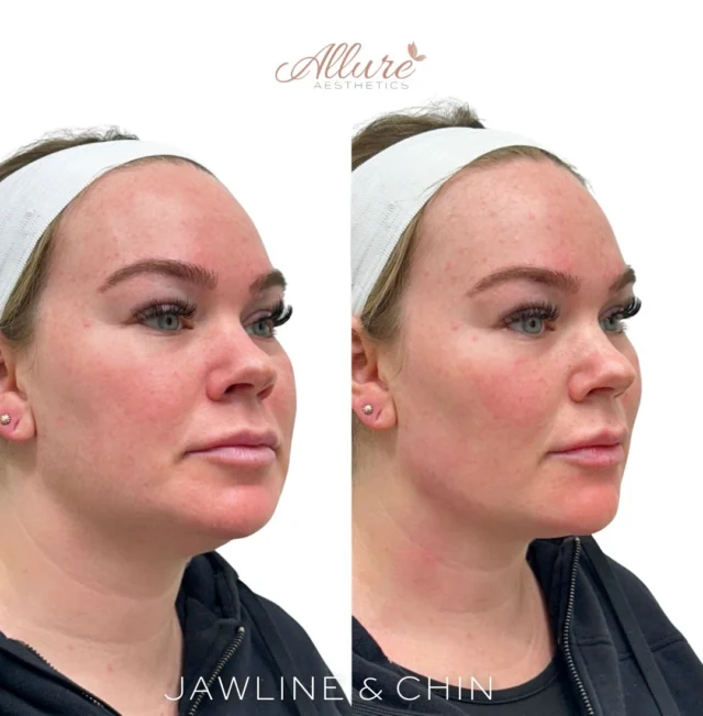 Jawline Contouring ✨

For this beautiful client, just one session was all it took to create more structure, balance, and definition along the jawline. By strategically placing filler, we were able to enhance her natural bone structure and bring harmony to her lower face - subtle, refined, and never overdone.

We also made minor adjustments to the chin and mentalis crease (the natural indentation between the lower lip and chin). By softening this area with precise filler placement, we were able to smooth the transition, improve projection, and create a more balanced profile overall.

✨ It’s all about working with your anatomy - not against it - for results that look natural, sculpted, and uniquely you.