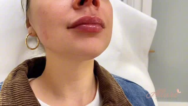 Freshly injected lips straight off the syringe 💉 

✨Swelling is present