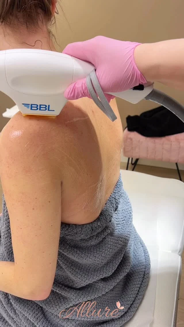 BroadBand Light Phototherapy (BBL) 🔆

Because smooth skin should be head-to-toe ✨

Targets sun damage, uneven tone, redness & texture to reveal smoother, clearer, more radiant skin.