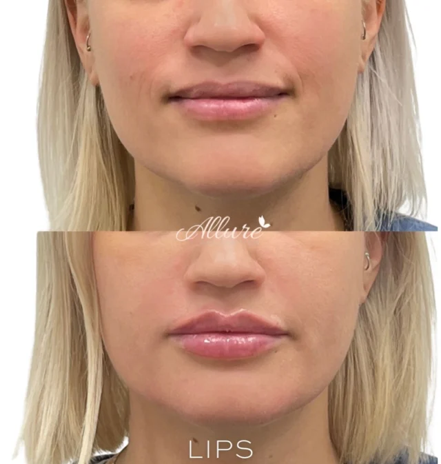 For this beautiful client, we focused on enhancing her natural anatomy by creating a defined Cupid’s bow, adding height to the upper lip, and refining overall shape and balance. ✨

The result? More structure, more definition, and beautifully balanced volume - without overpowering her features. 💋