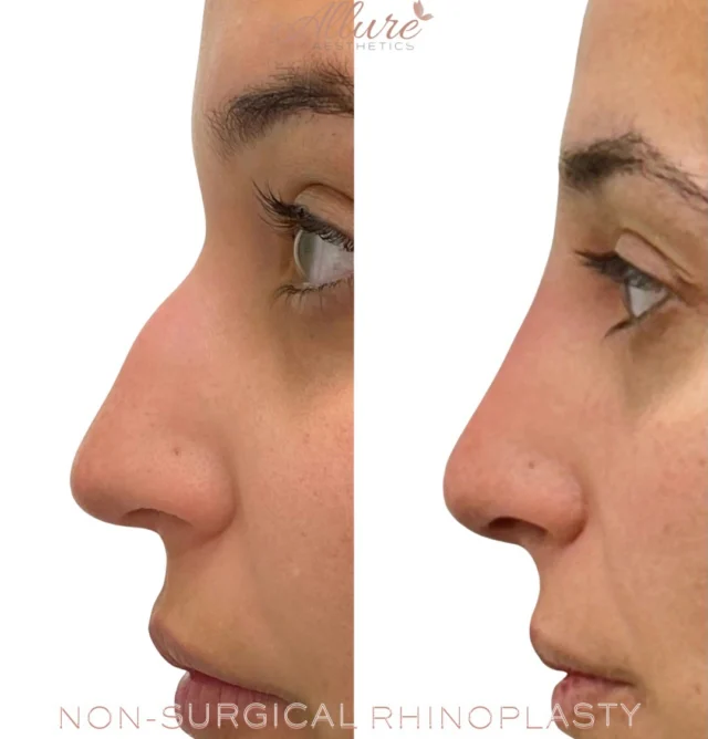 NON-SURGICAL RHINOPLASTY 👃 ✨

A safe, customized approach to refining the nose - no surgery required.

For this beautiful client, we treated her over multiple sessions to ensure safety, precision, and natural-looking results. By strategically placing filler, we were able to camouflage her dorsal hump, smooth the bridge, and create the appearance of a smaller, more balanced nose - all without altering her natural features.

This is the artistry of non-surgical rhinoplasty:
subtle refinement, facial harmony, and results that look effortless — not “done.”

Every nose is unique, which is why a gradual, session-by-session approach is often the safest way to achieve optimal results.

Results shown after multiple sessions. Individual results may vary. Consultation required.