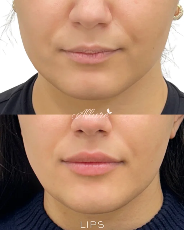 LIPS 💋

For this beautiful client, we focused on subtle enhancement with a natural, balanced finish.

We added more definition, built up her Cupid’s bow, improved symmetry, and boosted hydration for a soft, pillow-like look — without overfilling or changing her natural shape.

These are settled lips shown in the after photo — not immediately post-injection — so you’re seeing her true, healed results.

✨ Pillow-soft
✨ Defined
✨ Hydrated
✨ Naturally enhanced

Results shown after treatment. Individual results may vary. Consultation required.