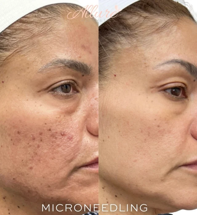 SkinPen Microneedling ✨ | After 2 Sessions

Microneedling stimulates your skin’s natural collagen and elastin production—helping improve:
• Fine lines
• Texture
• Pore appearance
• Overall skin tone

This transformation is after only two treatments 🤍
Results continue to improve with time and consistency.