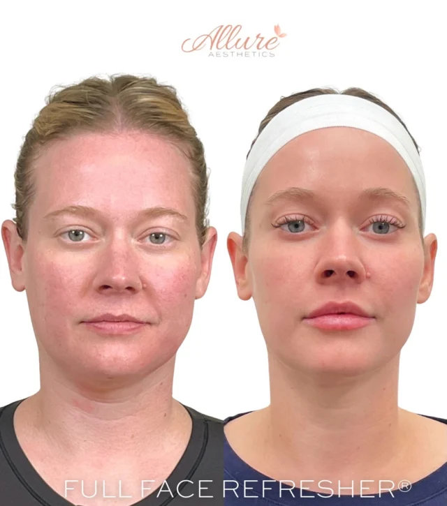 Allure's Full Face Refresher® 

No two faces are the same - and neither is our approach.
Our Full Face Refresher® is completely customized to enhance your natural features while maintaining balance, harmony, and structure.

For this client, her personalized plan included:
→ Cheeks
→ Lips
→ Dysport
→ Smile lines
→ Temples
→ Jawline
→ Chin

A subtle refresh. A confident glow.
Thoughtfully designed. Beautifully you. ✨