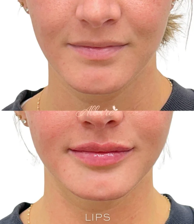 Lips 💋 

For this beauty we focused on enhancing balance and proportion to create a more symmetrical, harmonious lip shape, subtly building the top lip to improve structure while maintaining a soft, natural appearance. Strategic placement allowed us to define and enhance her Cupid’s bow, adding hydration and gentle volume for a smooth, plush, pillow-soft finish - never overdone.

✨ Results shown after ONE session
Fully customized to each client. Individual results may vary.